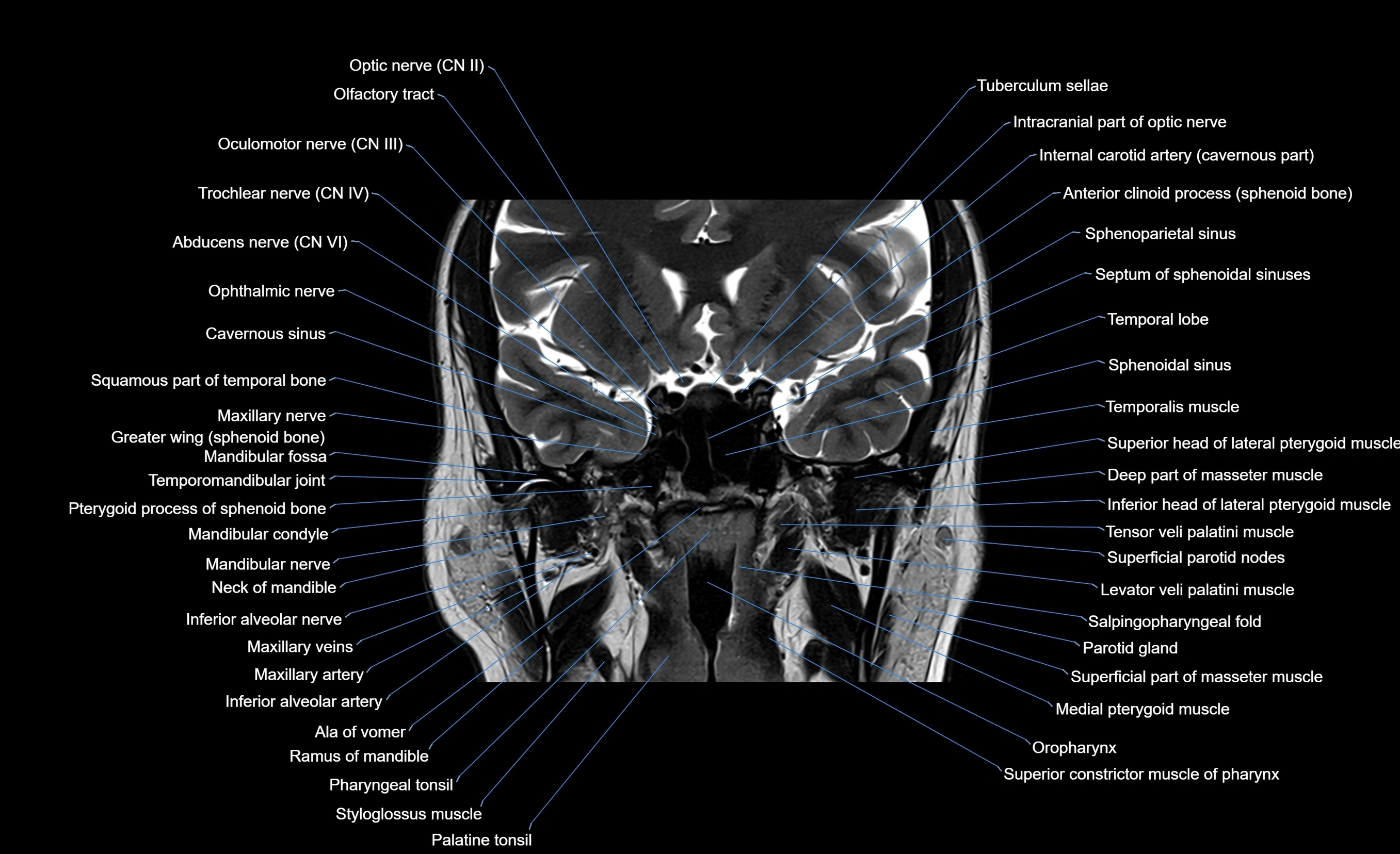 MRI face & paranasal sinuses(PNS) labelled  coronal  cross sectional anatomy 3T radiology  image-img-00001-00034.webp